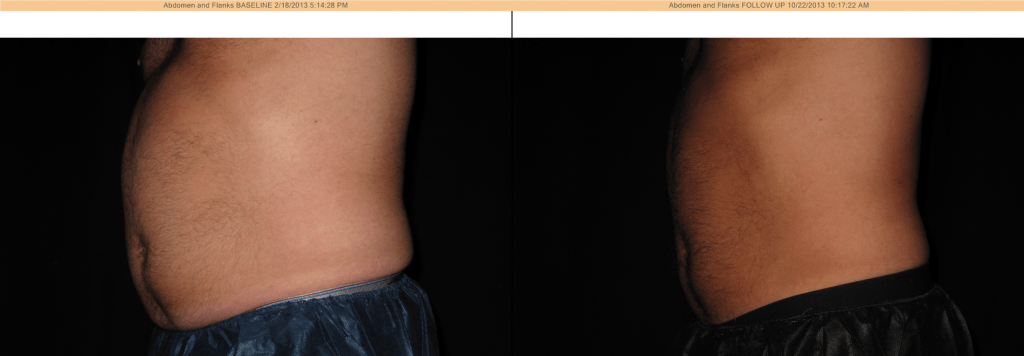 CoolSculpting Before & After - Abdomen and Flanks
