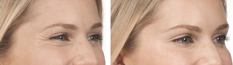 Botox treatment before and after pictures