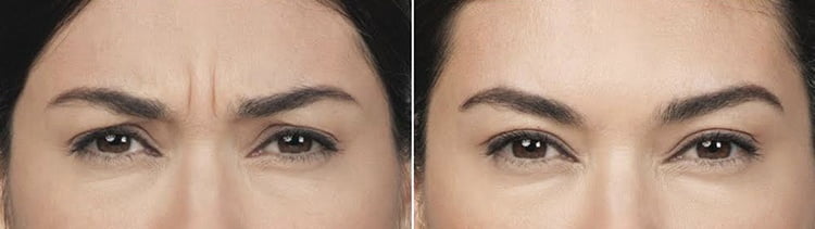 Botox Benefits