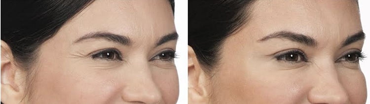 Botox treatment Bryn Mawr, PA