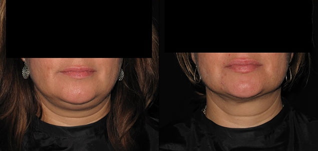 Facial Skin Tightening Procedure Philadelphia