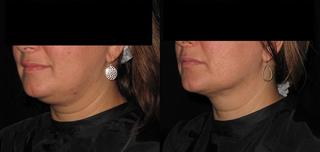 Invasive Skin Tightening Bryn Mawr, PA