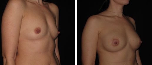 Breast Augmentation Surgery