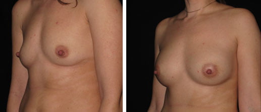 Breast Augmentation Fillers