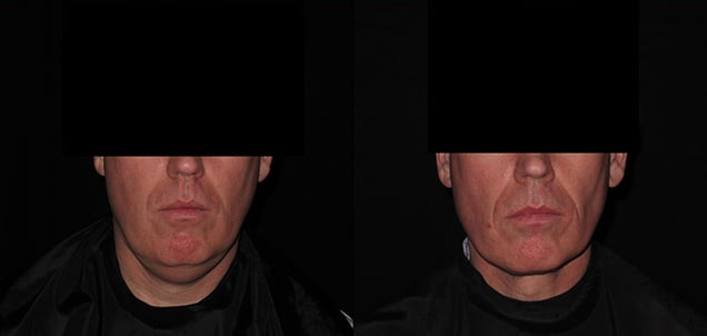 Facial Skin Tightening For Men Philadelphia