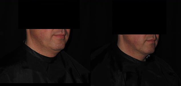 Facial Skin Tightening before and after pictures