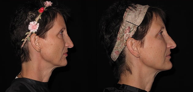 Natural Facelift - Lumen Fill