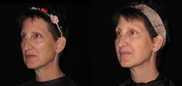 Natural Facelift Bryn Mawr, PA