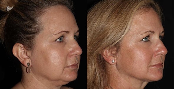 Facial Skin Tightening Benefits