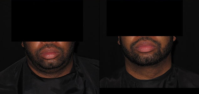 Facial Skin Tightening Advantages
