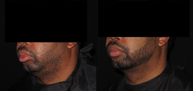 Facial Skin Tightening Reviews Philadelphia