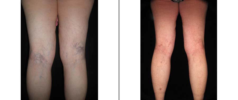 Sclerotherapy Before & After