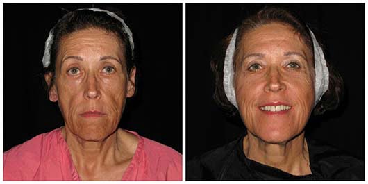 Natural Facelift Procedure Cost