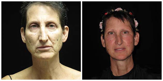 facelift near me