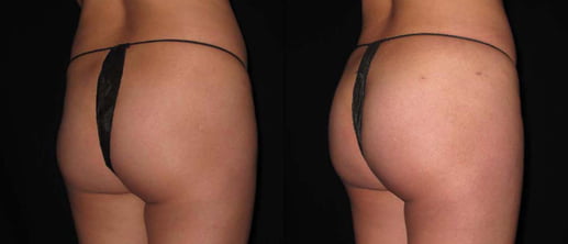Lumen Butt Lift