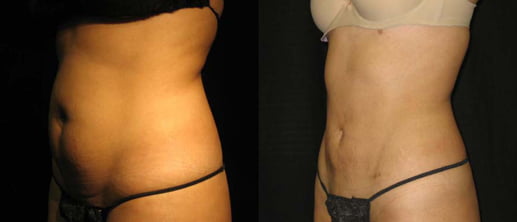 smartlipo gallery