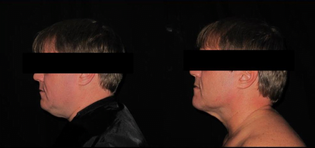 Lumen Tight Before & After