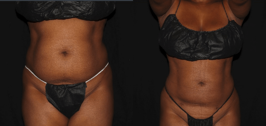 Renuvion J-Plasma Skin Tightening