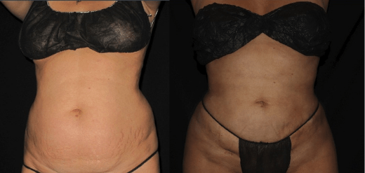 Renuvion J-Plasma Skin Tightening