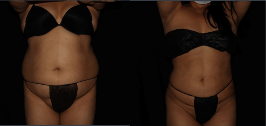 Renuvion J-Plasma Skin Tightening
