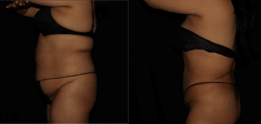 Renuvion J-Plasma Before & After