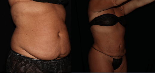 Renuvion J-Plasma Before & After