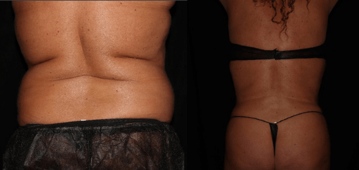 Renuvion jplasma results