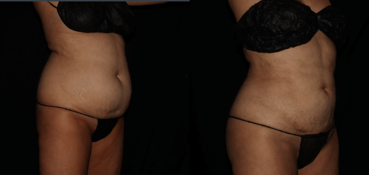 Renuvion jplasma results