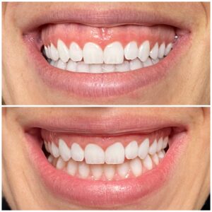 Before & After BOTOX lip flip Philadelphia