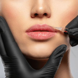 BOTOX Lip Flip