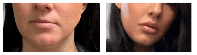 Lip Filler Before & After Philadelphia
