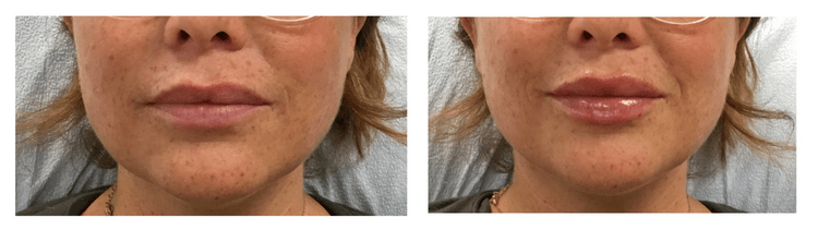 Lip Filler Before & After Philadelphia