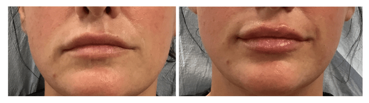 Lip Filler Before & After Main Line