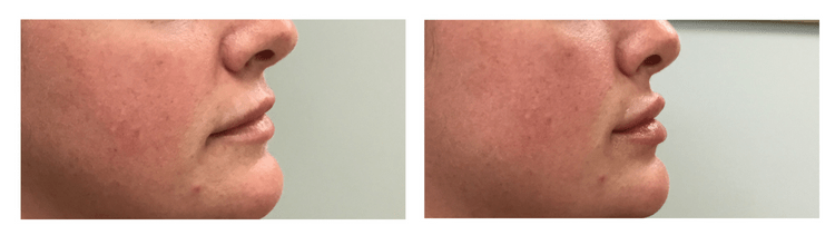 Lip Filler Before & After Main Line