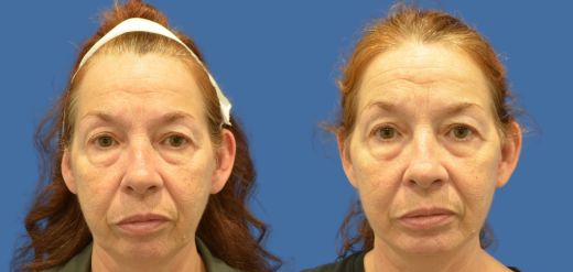 Mini facelift before and after Philadelphia, PA
