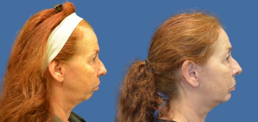 Mid facelift before and after Philadelphia, PA