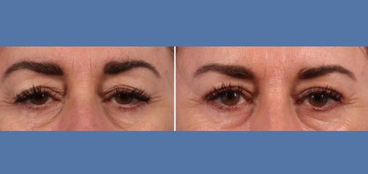 Bleph B&A_2 (520 x 247 px)