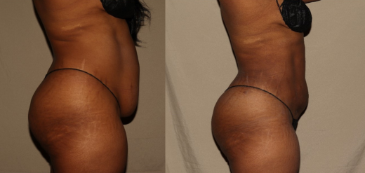 Laser Liposuction Before & After Philadelphia