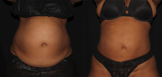 Laser Liposuction Before & After Philadelphia