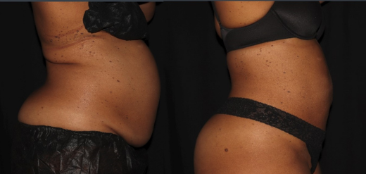 Laser Liposuction Before & After Philadelphia