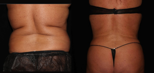 SmartLipo before and after