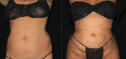 Renuvion before and after