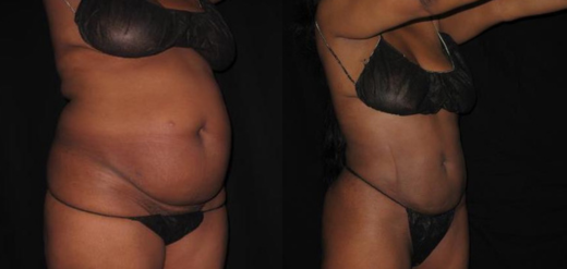SmartLipo Before & After