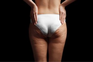Cellulite Go Away With Weight Loss