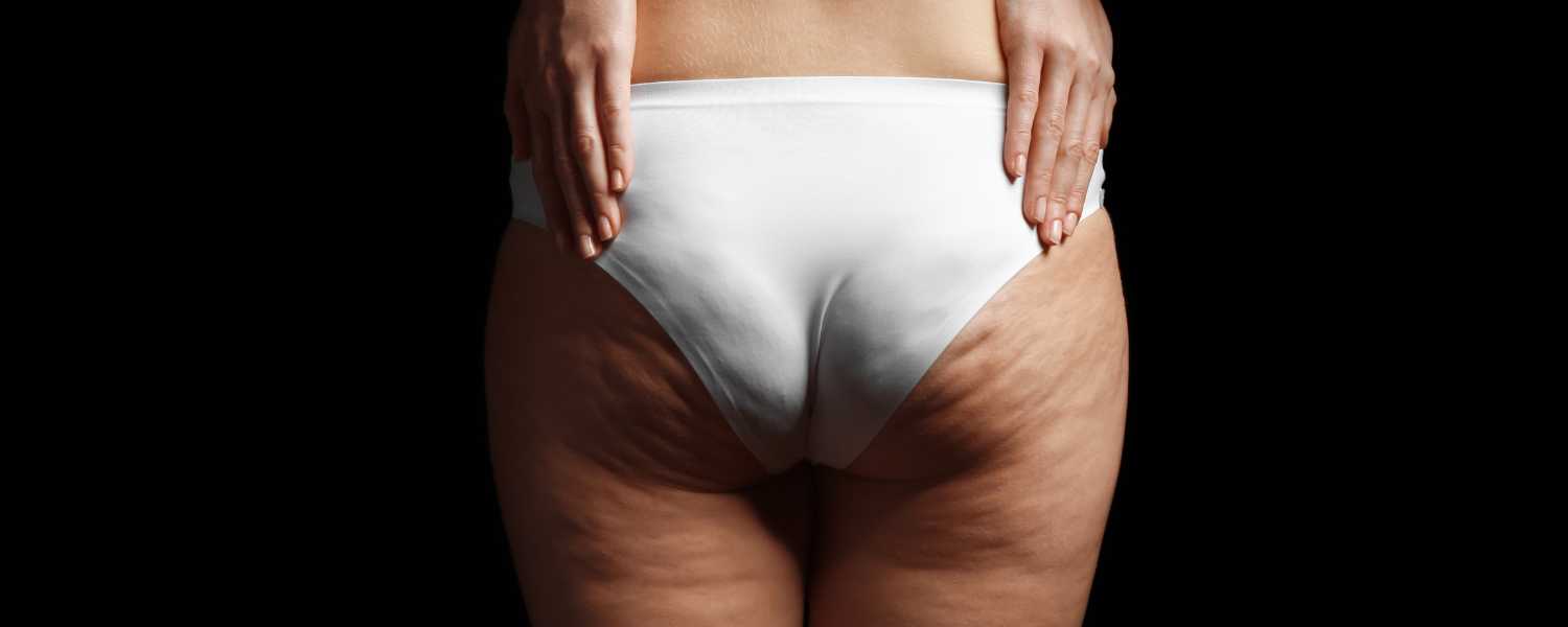 What Is Cellulite?