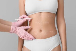 Good Candidate For Liposuction