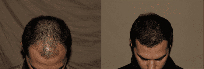 Before and after hair transplant surgery