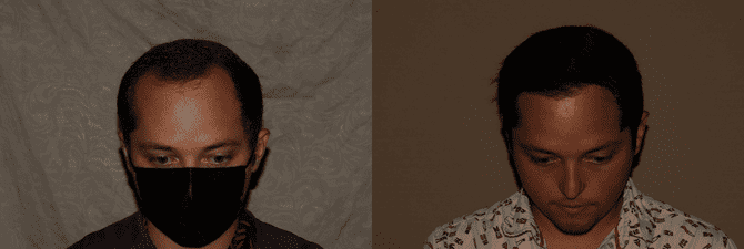 FUE Hair Transplant Philadelphia Before and After