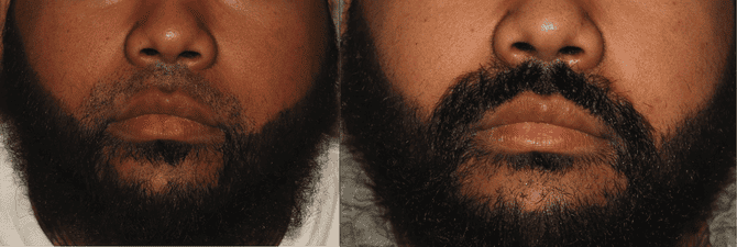 Facial Hair Transplant Philadelphia Before and After