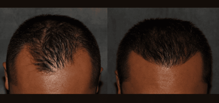 Hair Transplant FUE Procedure